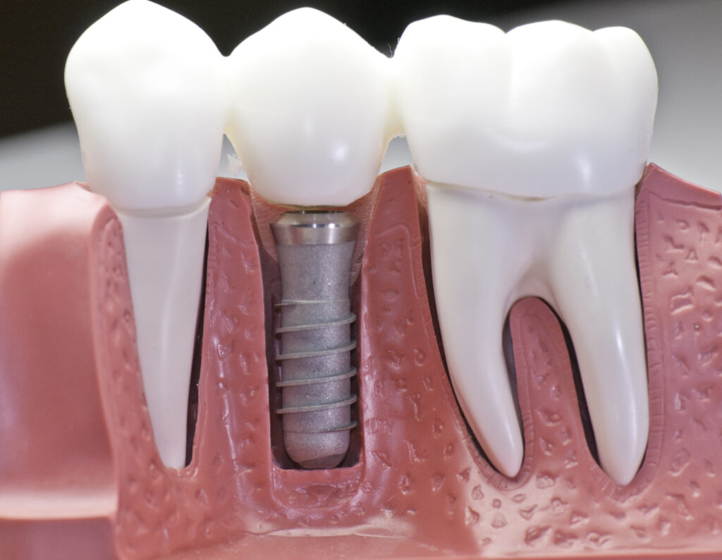 Implantes Dentários em Higienópolis