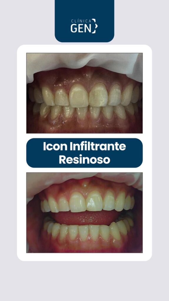 Icon Infiltrante Resinoso