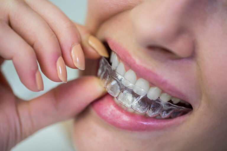 Invisalign (Alinhadores Invisíveis): Quais São as Suas Vantagens?
